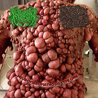 Padagra : Neurofibromathosis Type One Padagra : Neurofibromathosis Type One